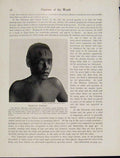 Old Vintage Print Primitive Surgery New Britain Bismarch Archipelago 1931 20th