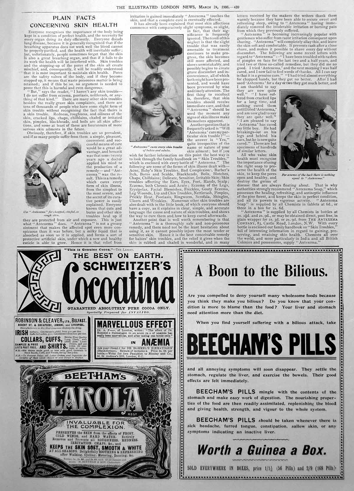 Antique Print Antexema Eczema Chaffed Hands Skin Schweitzers Cocoatina 1906